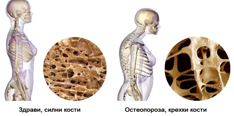 Превенция на остеопороза